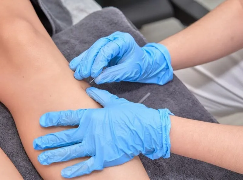 Dry Needling in Surrey and Langley: Relieve Pain and Restore Movement