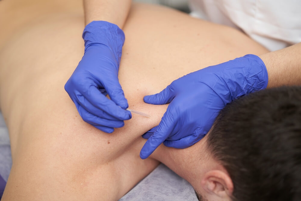 Dry Needling in Surrey and Langley, BC