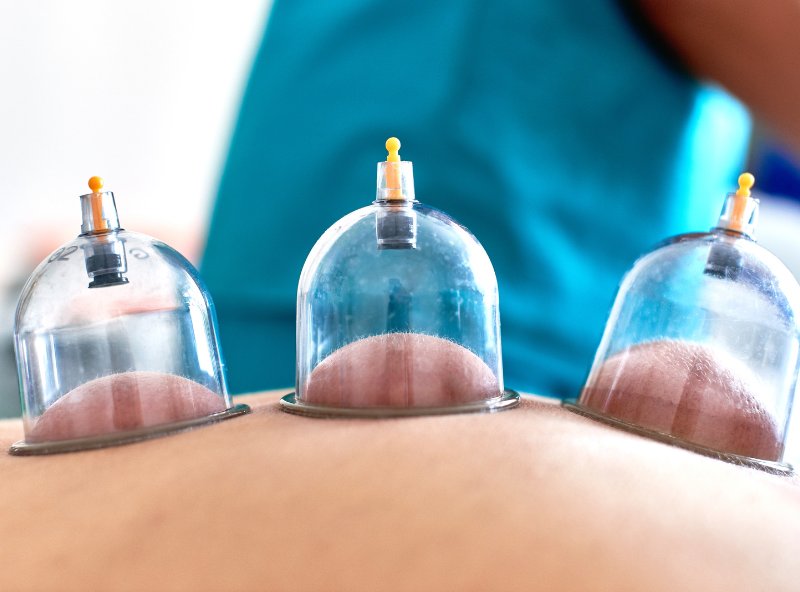 Cupping Therapy Langley | A Natural Path to Pain Relief & Mobility